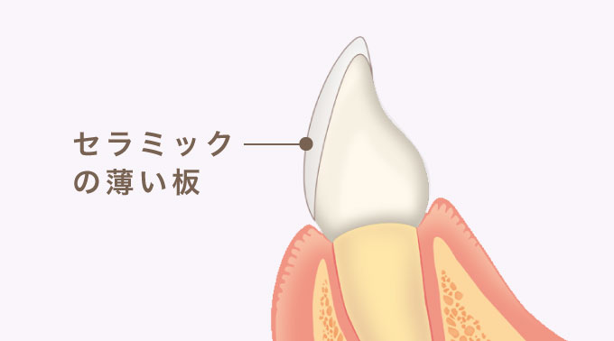 ラミネートベニア