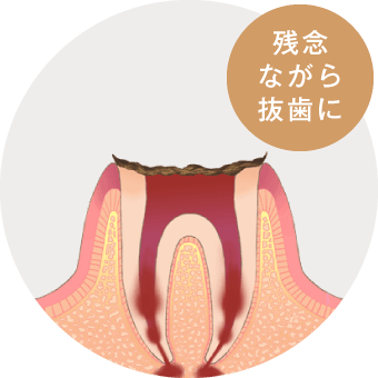 残念ながら抜歯に
