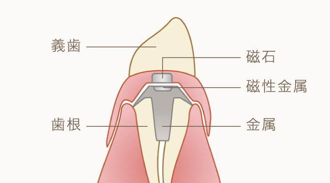 アタッチメント義歯