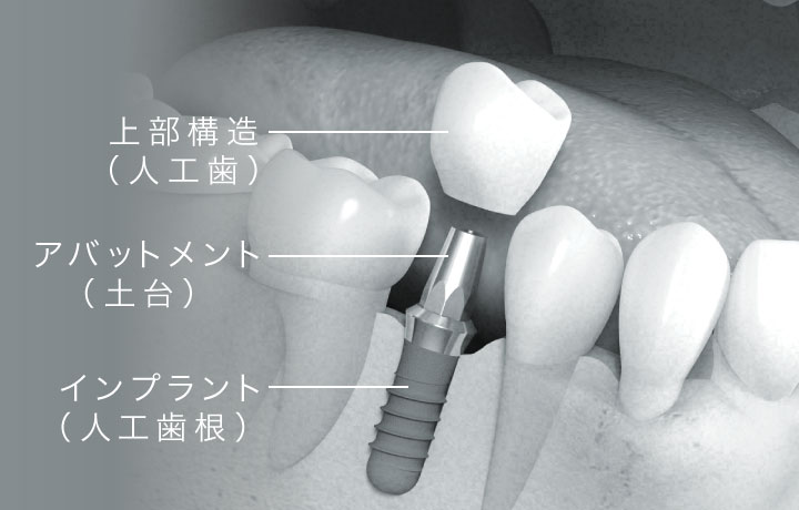 上部構造（人工歯）、アバットメント（土台）、インプラント（人工歯根）
