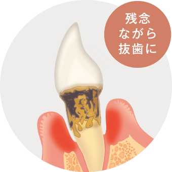 残念ながら抜歯に