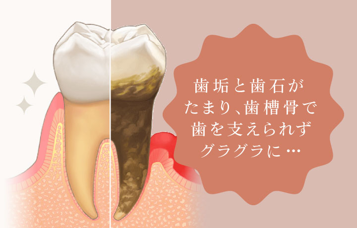 歯垢と歯石がたまり、歯槽骨で歯を支えられずグラグラに