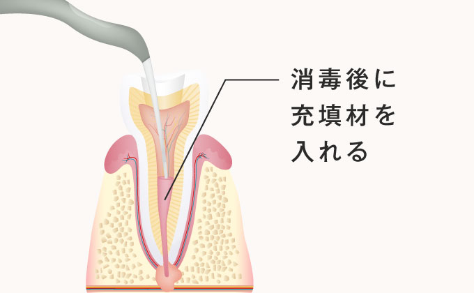 消毒後に充填剤を入れる