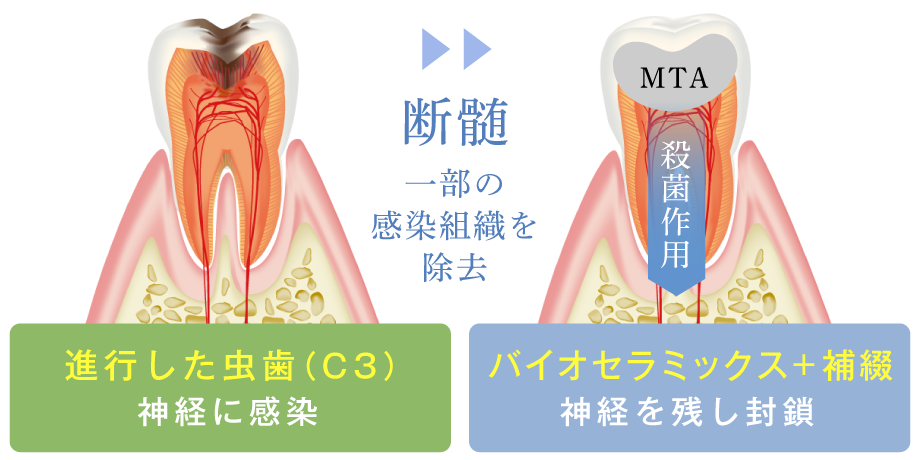 神経に感染した虫歯(C3)を断髄により神経を残したまま封鎖