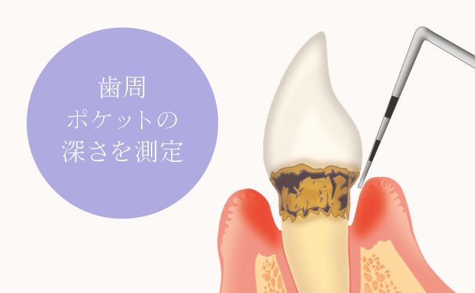 歯周ポケットの深さを測定