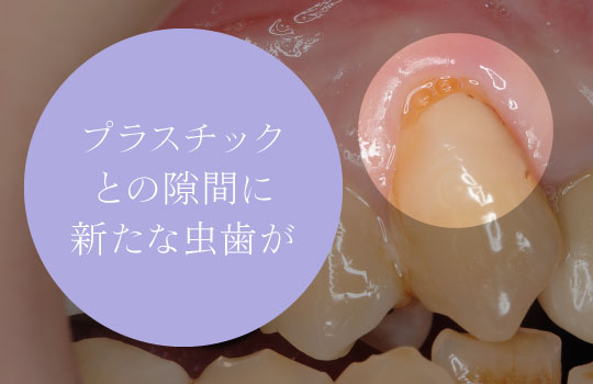 プラスチックとの隙間に新たな虫歯が