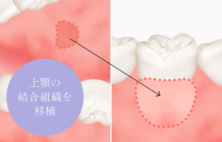 上顎の結合組織を移植