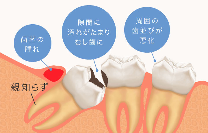 親知らずは「歯茎の腫れ」「隙間に汚れがたまりむし歯に」「周囲の歯並びが悪化」などの原因に